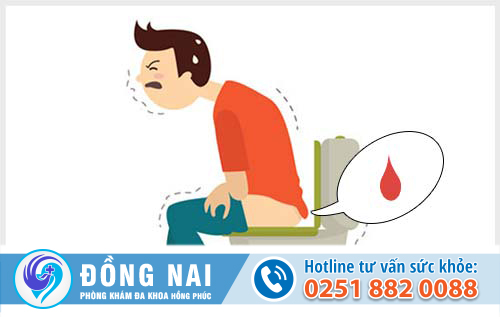 Đại tiện ra máu là triệu chứng ban đầu của trĩ ngoại