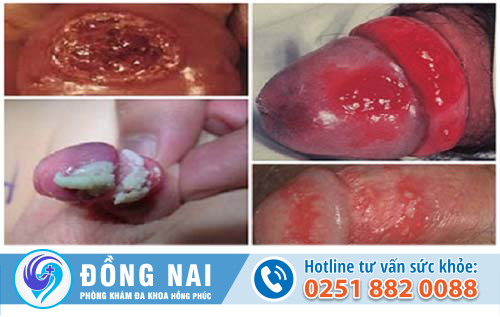 Tại sao dương vật lại bị ngứa và lở loét?