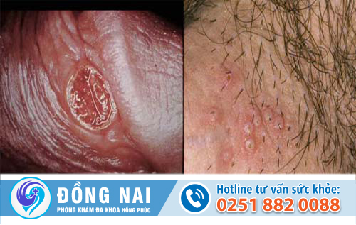 Tại sao dương vật lại bị ngứa và lở loét?