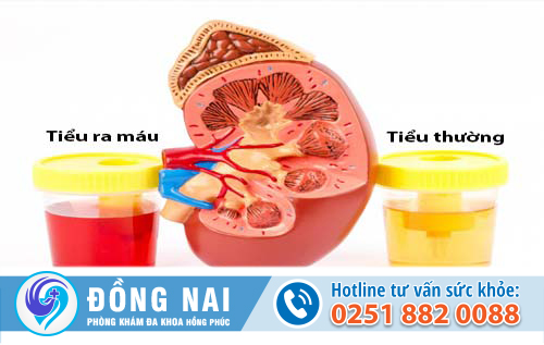 Tại sao nam giới tiểu ra máu?