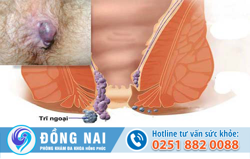 Tất tần tật về bệnh trĩ tắc mạch