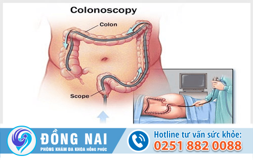 Thế nào là nội soi trĩ?