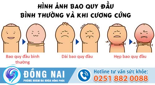 Thế nào là được gọi bao quy đầu bình thường?