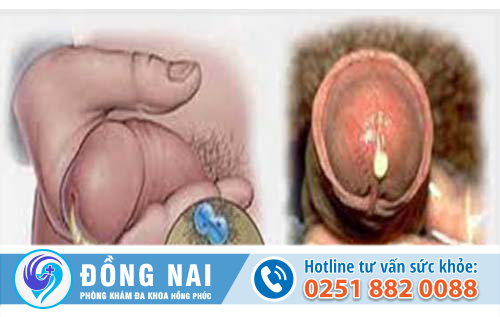 Tiểu ra mủ vàng là dấu hiệu bệnh gì?