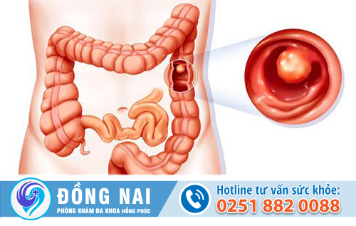 Tìm hiểu về bệnh Polyp hậu môn