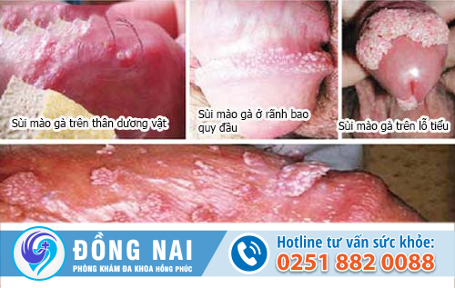 Một số bệnh về dương vật phổ biến ở nam giới – Phần 2