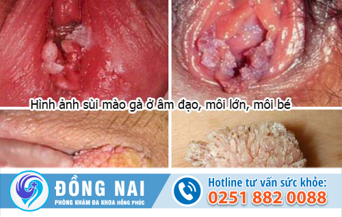 hình ảnh bệnh xã hội sùi mào gà nữ