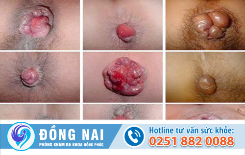 trĩ hỗn hợp