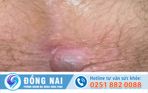 trĩ ngoại độ 1