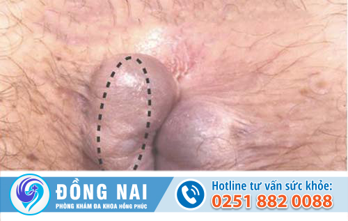 trĩ ngoại độ 2