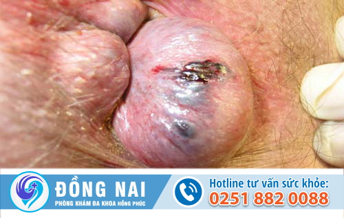trĩ ngoại độ 3