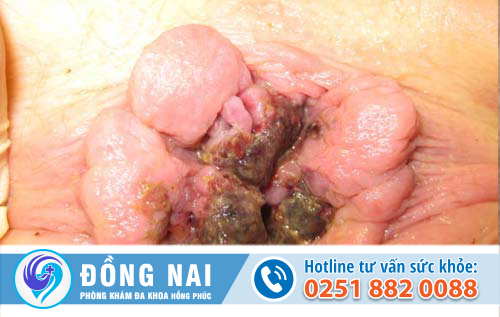 trĩ ngoại độ 4