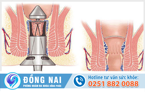 Điều trị trĩ nội bằng phương pháp HCPT