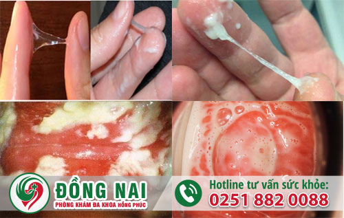 Những triệu chứng của bệnh viêm âm đạo