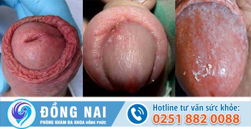 Viêm bao quy đầu – Căn bệnh thường gặp ở nam giới