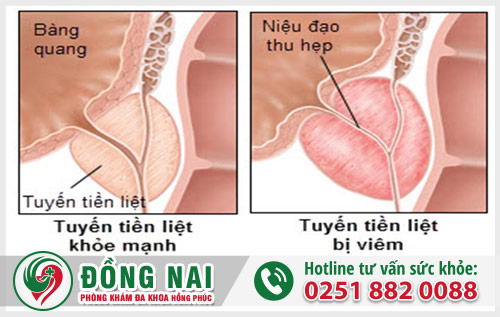 Viêm tuyến tiền liệt nam giới – liệu bạn có đang mắc phải?
