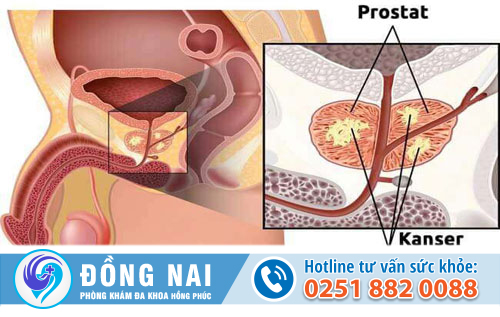 Vôi hóa tuyến tiền liệt là bệnh gì, có nguy hiểm không?