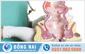 Bệnh hậu môn gồm những bệnh gì?