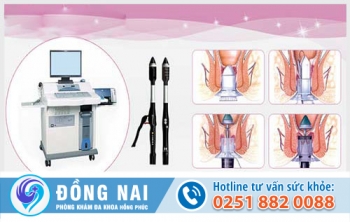 Mổ trĩ bằng máy PPH-HCPT là như thế nào? Có đau không?