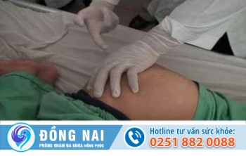 Hậu môn chảy mủ là bị bệnh gì?