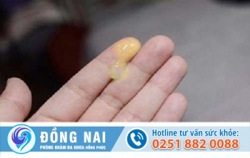 Nguy hại từ tình trạng dương vật chảy mủ vàng