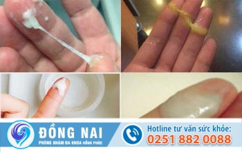 Các biểu hiện của khí hư bất thường